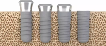 種植體，在全球牙科設備市場的變化！