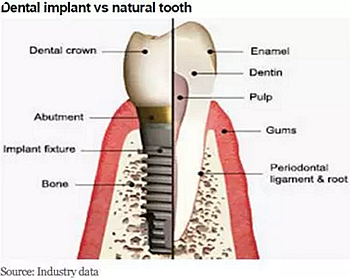 種植體，在全球牙科設備市場的變化！