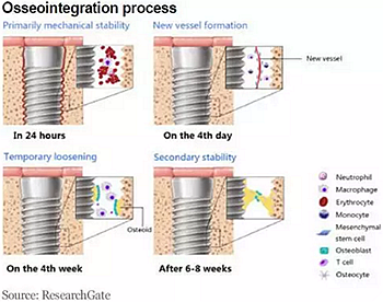 種植體，在全球牙科設備市場的變化！