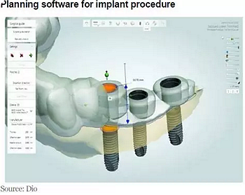 種植體，在全球牙科設備市場的變化！