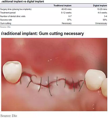 種植體，在全球牙科設備市場的變化！