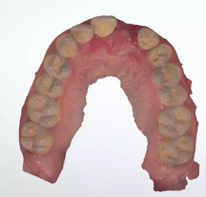 數(shù)字化修復(fù)病例分享 | 21單顆牙齒種植修復(fù) 數(shù)字化修復(fù)病例分享 | 21單顆牙齒種植修復(fù)