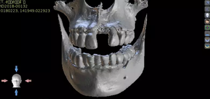 數(shù)字化修復(fù)病例分享 | 21單顆牙齒種植修復(fù) 數(shù)字化修復(fù)病例分享 | 21單顆牙齒種植修復(fù)