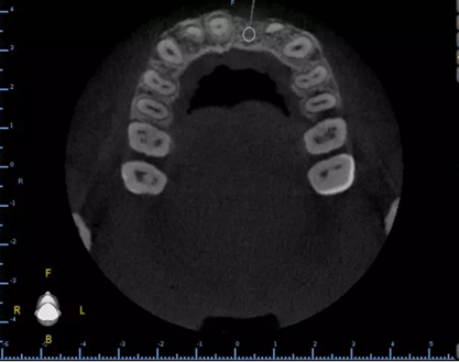 數(shù)字化修復(fù)病例分享 | 21單顆牙齒種植修復(fù) 數(shù)字化修復(fù)病例分享 | 21單顆牙齒種植修復(fù)