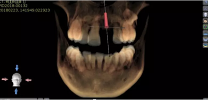 數(shù)字化修復(fù)病例分享 | 21單顆牙齒種植修復(fù) 數(shù)字化修復(fù)病例分享 | 21單顆牙齒種植修復(fù)