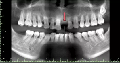數(shù)字化修復(fù)病例分享 | 21單顆牙齒種植修復(fù) 數(shù)字化修復(fù)病例分享 | 21單顆牙齒種植修復(fù)