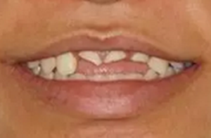 【病例分享】上頜多顆相鄰前牙的“精確化”即刻種植修復(fù)一例 【病例分享】上頜多顆相鄰前牙的“精確化”即刻種植修復(fù)一例