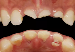 【病例分享】上頜多顆相鄰前牙的“精確化”即刻種植修復(fù)一例 【病例分享】上頜多顆相鄰前牙的“精確化”即刻種植修復(fù)一例