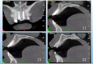 【病例分享】上頜多顆相鄰前牙的“精確化”即刻種植修復(fù)一例 【病例分享】上頜多顆相鄰前牙的“精確化”即刻種植修復(fù)一例