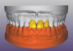 【病例分享】上頜多顆相鄰前牙的“精確化”即刻種植修復(fù)一例 【病例分享】上頜多顆相鄰前牙的“精確化”即刻種植修復(fù)一例