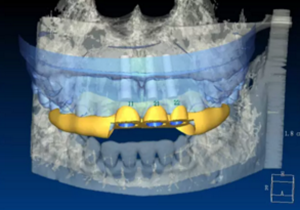 【病例分享】上頜多顆相鄰前牙的“精確化”即刻種植修復(fù)一例 【病例分享】上頜多顆相鄰前牙的“精確化”即刻種植修復(fù)一例