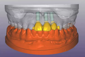 【病例分享】上頜多顆相鄰前牙的“精確化”即刻種植修復(fù)一例 【病例分享】上頜多顆相鄰前牙的“精確化”即刻種植修復(fù)一例