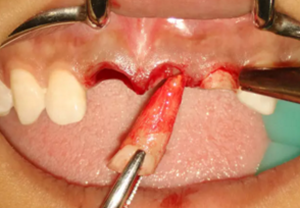 【病例分享】上頜多顆相鄰前牙的“精確化”即刻種植修復(fù)一例 【病例分享】上頜多顆相鄰前牙的“精確化”即刻種植修復(fù)一例