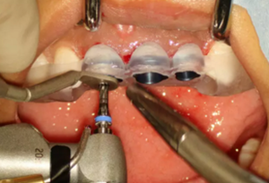 【病例分享】上頜多顆相鄰前牙的“精確化”即刻種植修復(fù)一例 【病例分享】上頜多顆相鄰前牙的“精確化”即刻種植修復(fù)一例