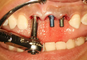 【病例分享】上頜多顆相鄰前牙的“精確化”即刻種植修復(fù)一例 【病例分享】上頜多顆相鄰前牙的“精確化”即刻種植修復(fù)一例