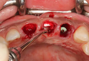 【病例分享】上頜多顆相鄰前牙的“精確化”即刻種植修復(fù)一例 【病例分享】上頜多顆相鄰前牙的“精確化”即刻種植修復(fù)一例