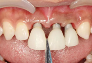 【病例分享】上頜多顆相鄰前牙的“精確化”即刻種植修復(fù)一例 【病例分享】上頜多顆相鄰前牙的“精確化”即刻種植修復(fù)一例