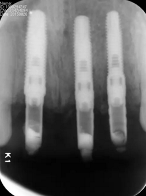 【病例分享】上頜多顆相鄰前牙的“精確化”即刻種植修復(fù)一例 【病例分享】上頜多顆相鄰前牙的“精確化”即刻種植修復(fù)一例