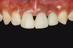 【病例分享】上頜多顆相鄰前牙的“精確化”即刻種植修復(fù)一例 【病例分享】上頜多顆相鄰前牙的“精確化”即刻種植修復(fù)一例