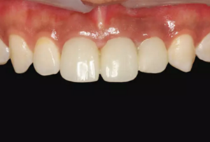 【病例分享】上頜多顆相鄰前牙的“精確化”即刻種植修復(fù)一例 【病例分享】上頜多顆相鄰前牙的“精確化”即刻種植修復(fù)一例