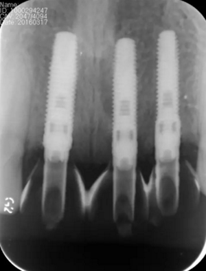 【病例分享】上頜多顆相鄰前牙的“精確化”即刻種植修復(fù)一例 【病例分享】上頜多顆相鄰前牙的“精確化”即刻種植修復(fù)一例