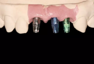 【病例分享】上頜多顆相鄰前牙的“精確化”即刻種植修復(fù)一例 【病例分享】上頜多顆相鄰前牙的“精確化”即刻種植修復(fù)一例