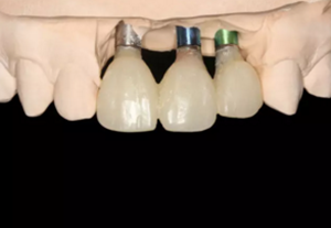 【病例分享】上頜多顆相鄰前牙的“精確化”即刻種植修復(fù)一例 【病例分享】上頜多顆相鄰前牙的“精確化”即刻種植修復(fù)一例