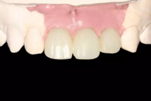 【病例分享】上頜多顆相鄰前牙的“精確化”即刻種植修復(fù)一例 【病例分享】上頜多顆相鄰前牙的“精確化”即刻種植修復(fù)一例