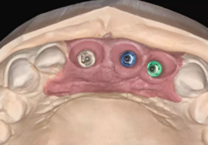 【病例分享】上頜多顆相鄰前牙的“精確化”即刻種植修復(fù)一例 【病例分享】上頜多顆相鄰前牙的“精確化”即刻種植修復(fù)一例