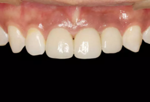 【病例分享】上頜多顆相鄰前牙的“精確化”即刻種植修復(fù)一例 【病例分享】上頜多顆相鄰前牙的“精確化”即刻種植修復(fù)一例