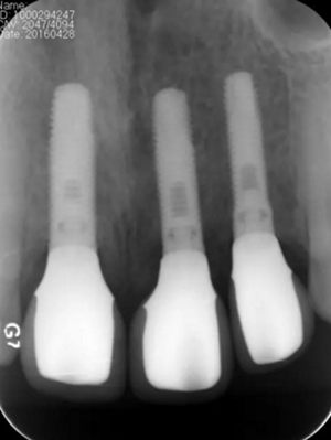 【病例分享】上頜多顆相鄰前牙的“精確化”即刻種植修復(fù)一例 【病例分享】上頜多顆相鄰前牙的“精確化”即刻種植修復(fù)一例
