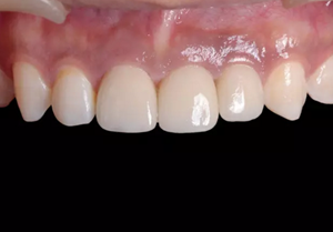 【病例分享】上頜多顆相鄰前牙的“精確化”即刻種植修復(fù)一例 【病例分享】上頜多顆相鄰前牙的“精確化”即刻種植修復(fù)一例