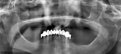 CARES?綜合的數(shù)字化解決方案---3D打印全程導(dǎo)板引導(dǎo)下植入病例一例 CARES?綜合的數(shù)字化解決方案---3D打印全程導(dǎo)板引導(dǎo)下植入病例一例