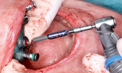 CARES?綜合的數(shù)字化解決方案---3D打印全程導(dǎo)板引導(dǎo)下植入病例一例 CARES?綜合的數(shù)字化解決方案---3D打印全程導(dǎo)板引導(dǎo)下植入病例一例