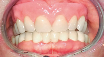 CARES?綜合的數(shù)字化解決方案---3D打印全程導(dǎo)板引導(dǎo)下植入病例一例 CARES?綜合的數(shù)字化解決方案---3D打印全程導(dǎo)板引導(dǎo)下植入病例一例