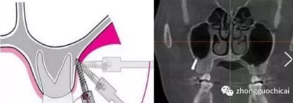 特殊植入部位及注意事項(xiàng) 特殊植入部位及注意事項(xiàng)