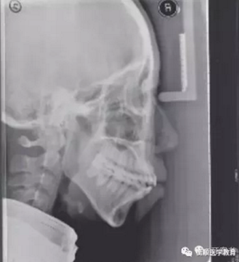 病例精選 | 骨性Ⅱ類高角面型矯治病例 病例精選 | 骨性Ⅱ類高角面型矯治病例