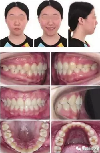 病例精選 | 骨性Ⅱ類高角面型矯治病例 病例精選 | 骨性Ⅱ類高角面型矯治病例