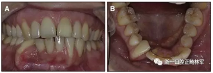 正畸文獻閱讀--正畸保持手段的流行病學研究 正畸文獻閱讀--正畸保持手段的流行病學研究