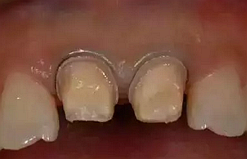 雙線排齦在口腔臨床冠修復(fù)上的應(yīng)用 雙線排齦在口腔臨床冠修復(fù)上的應(yīng)用