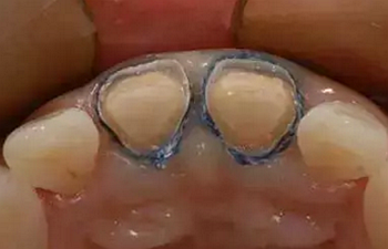 雙線排齦在口腔臨床冠修復(fù)上的應(yīng)用 雙線排齦在口腔臨床冠修復(fù)上的應(yīng)用