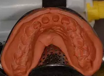 雙線排齦在口腔臨床冠修復(fù)上的應(yīng)用 雙線排齦在口腔臨床冠修復(fù)上的應(yīng)用