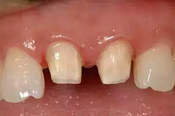 雙線排齦在口腔臨床冠修復(fù)上的應(yīng)用 雙線排齦在口腔臨床冠修復(fù)上的應(yīng)用