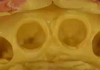 雙線排齦在口腔臨床冠修復(fù)上的應(yīng)用 雙線排齦在口腔臨床冠修復(fù)上的應(yīng)用