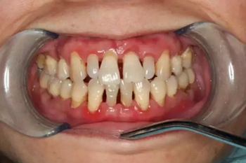 牙齦碰不得，一碰就出血。這是咋回事？