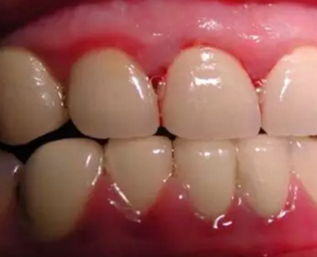 牙齦碰不得，一碰就出血。這是咋回事？