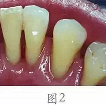 	 牙齦碰不得，一碰就出血。這是咋回事？