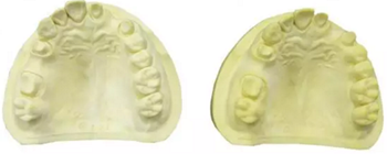 【分享】高水平義齒制作工藝流程 【分享】高水平義齒制作工藝流程