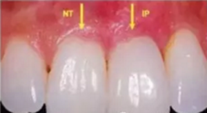 美學種植治療---軟組織的處理 美學種植治療---軟組織的處理