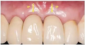 美學種植治療---軟組織的處理 美學種植治療---軟組織的處理